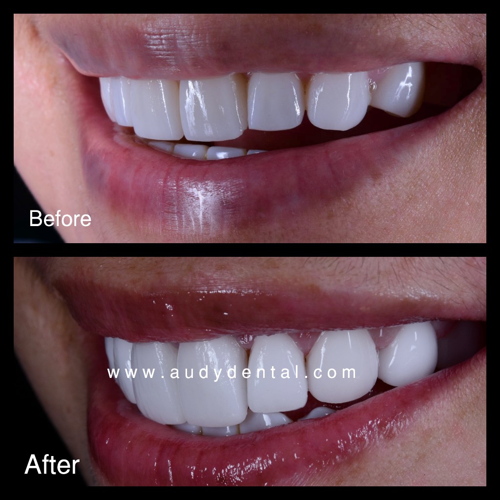  harga  veneer gigi jakarta audy dental 4 Audy Dental