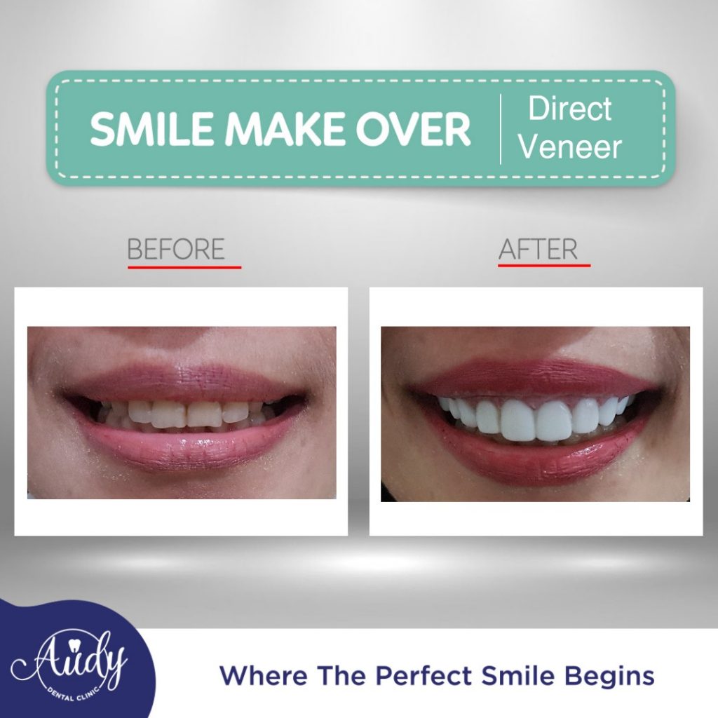  harga  veneer gigi jakarta audy dental 4 Audy Dental