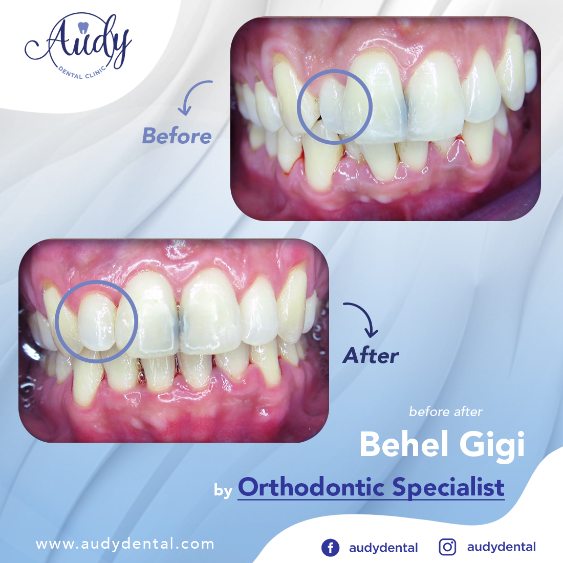  Behel  Lingual Audy Dental