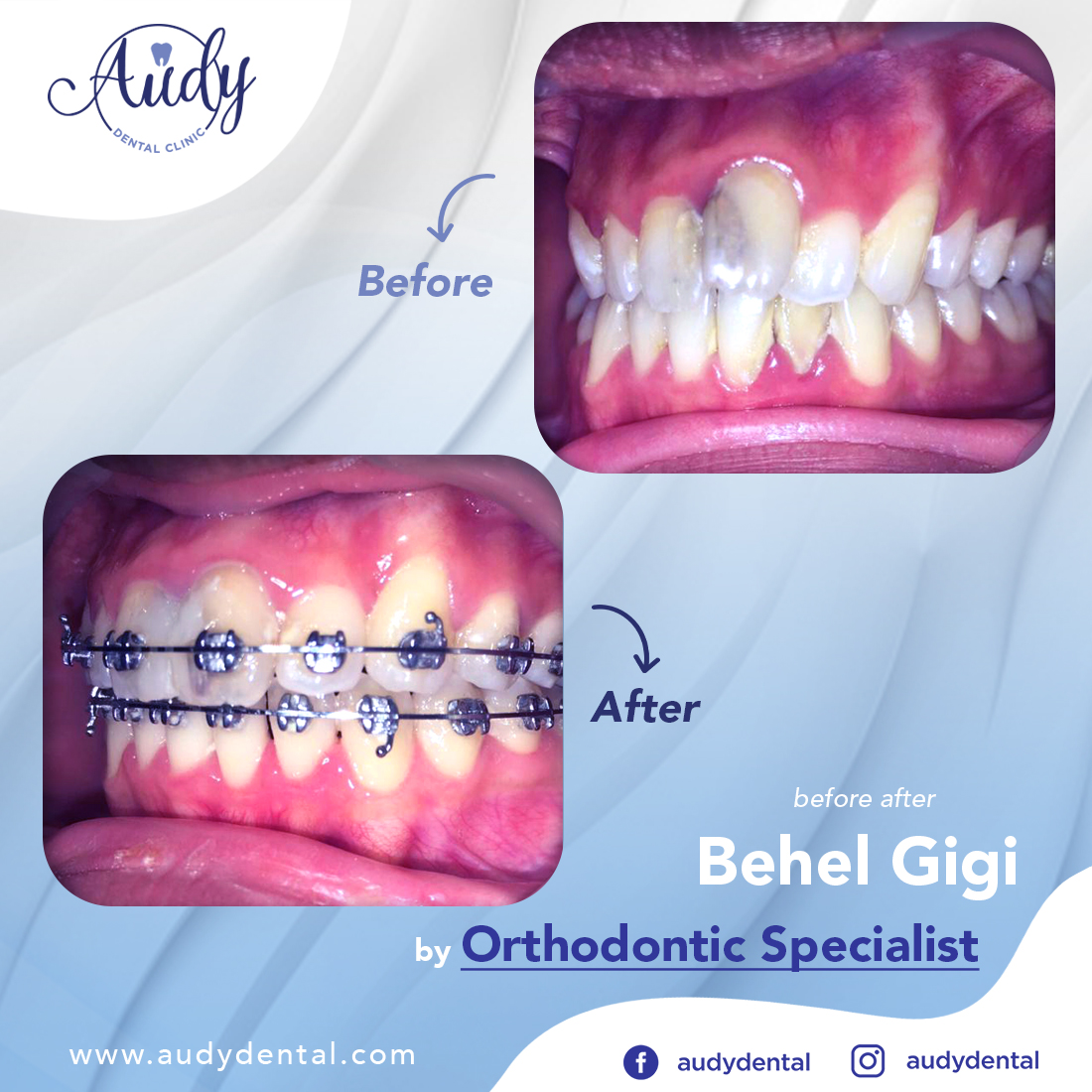  Behel  Metal Audy Dental