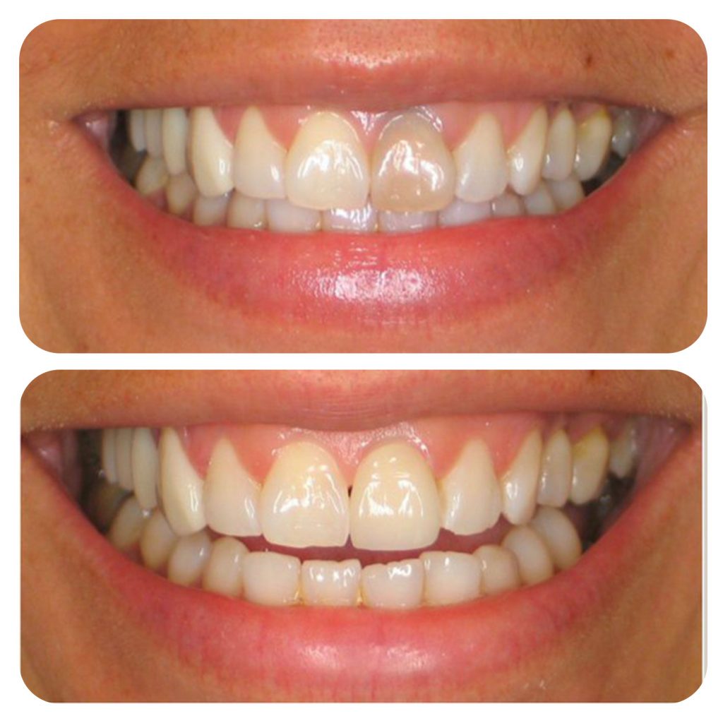  internal bleaching  Audy Dental