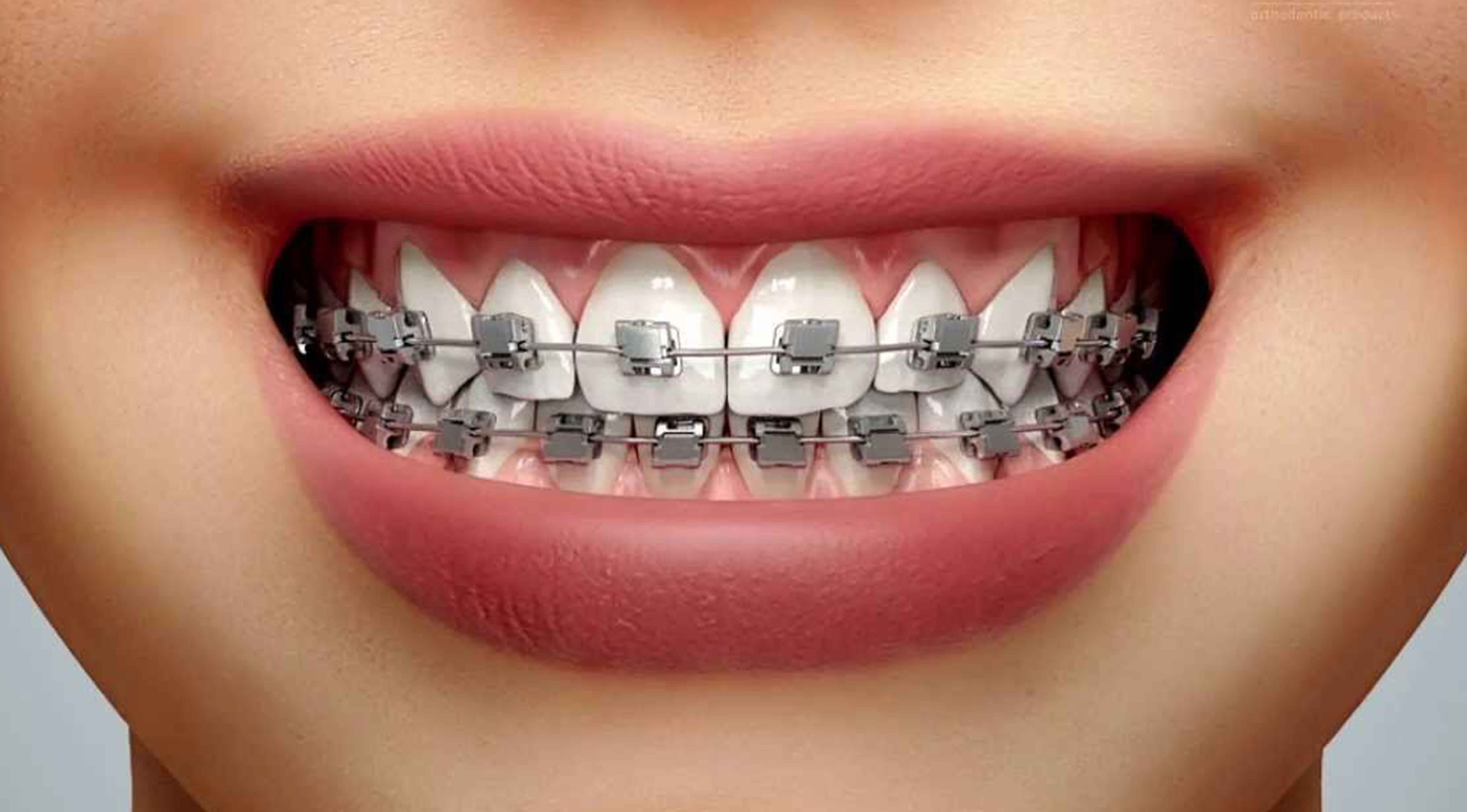 Self Ligating Braces Audy Dental Services Audy Dental