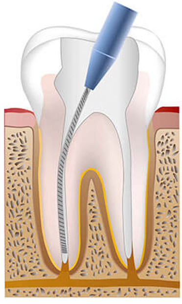 Proses Perawatan Saluran Akar Gigi Homecare24